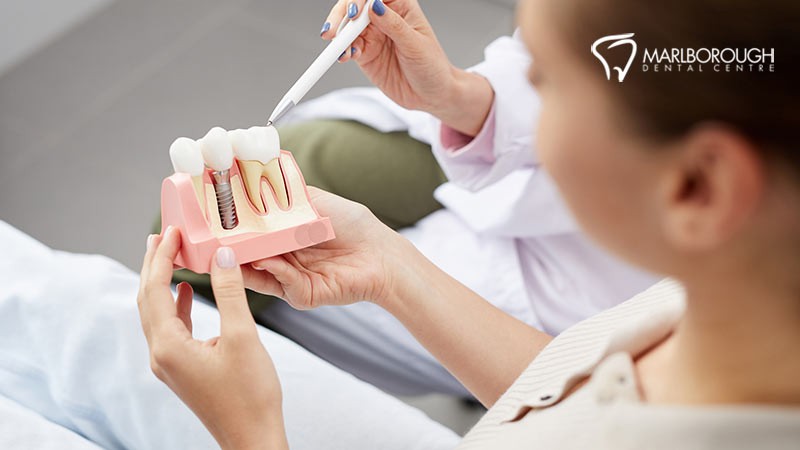 6 Of The Top Benefits of Dental Implants! - NE Calgary Dentist