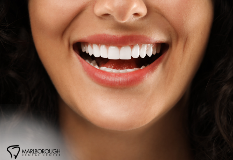 Are Veneers Right for You? Here’s How to Decide 