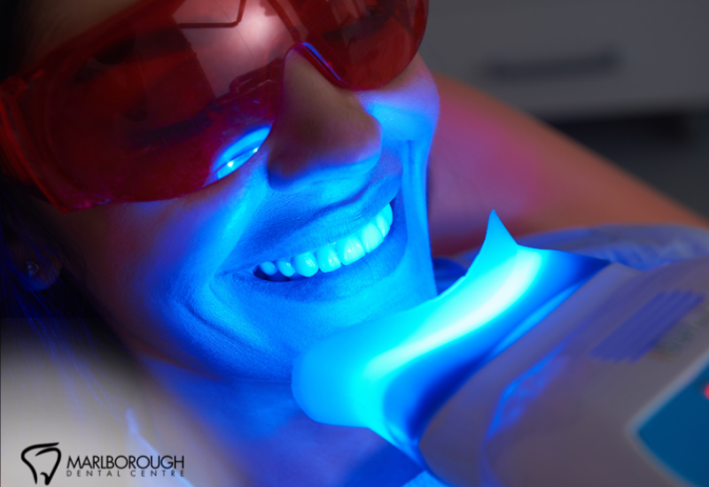  Is It Safe to Whiten Your Teeth at Home? What a Calgary Dentist Recommends 