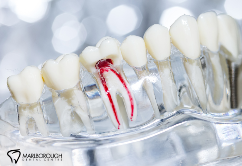 What to Expect During a Root Canal at Our Calgary Dental Clinic 