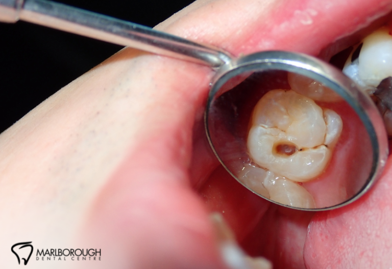 Do Dental Fillings Hurt? What Calgary Patients Should Know Before Treatment 