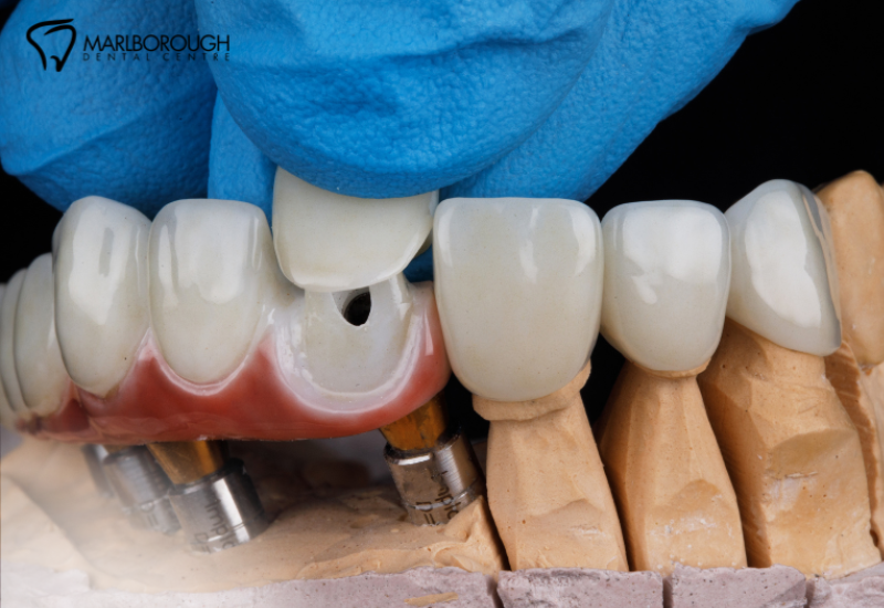 3 Warning Signs You Might Need a Dental Crown in Calgary 