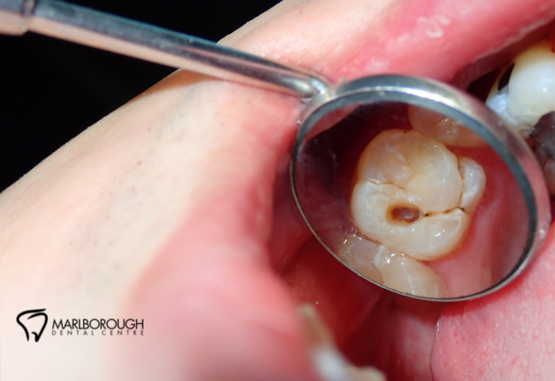 Emergency Dentist in NE Calgary: When to Call and What to Expect 