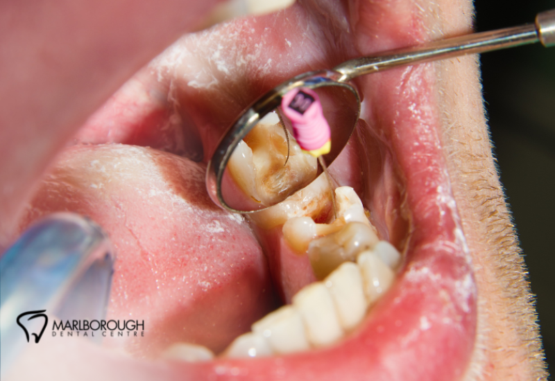 Root Canal Relief: What to Expect at Marlborough Dental Centre 