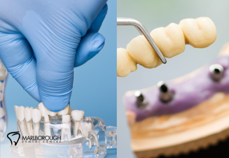 Crowns vs. Bridges: Choosing the Right Fix for Calgary Patients 