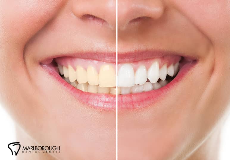 Which Stains Teeth Whitening Can Remove And Those It Can't