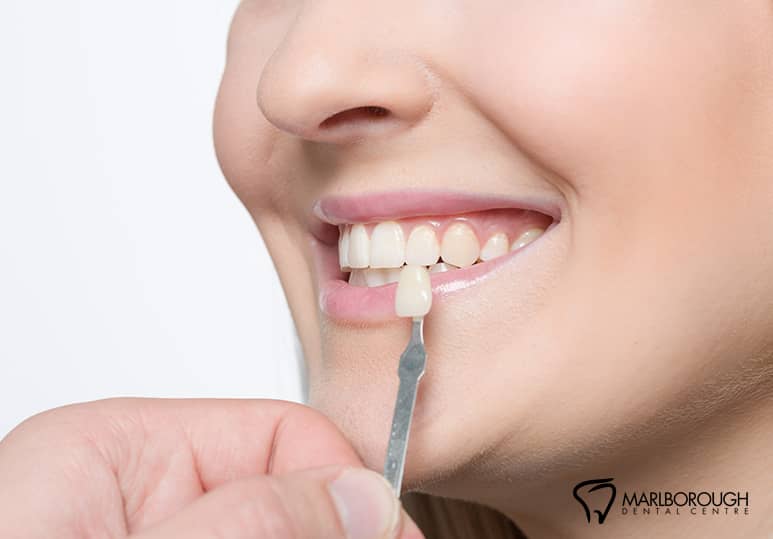 How To Protect Your Veneers From Damage