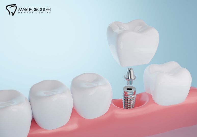 Innovations and Advancements in Dental Implant Technology: A New Era of Oral Health