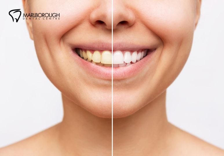 Calgary Teeth Whitening: 5 Reasons to Choose Professional Teeth Whitening in Calgary