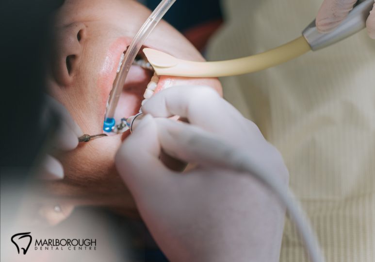 Calgary Root Canals: How They Relieve Pain & Restore Dental Health