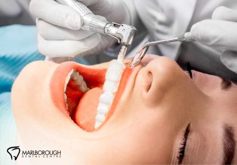 How Calgary Dental Exams Help Prevent Cavities and Gum Disease 