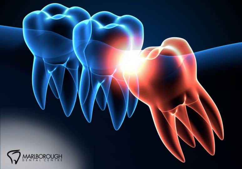 Signs You Need Wisdom Teeth Removal: Is It Time?