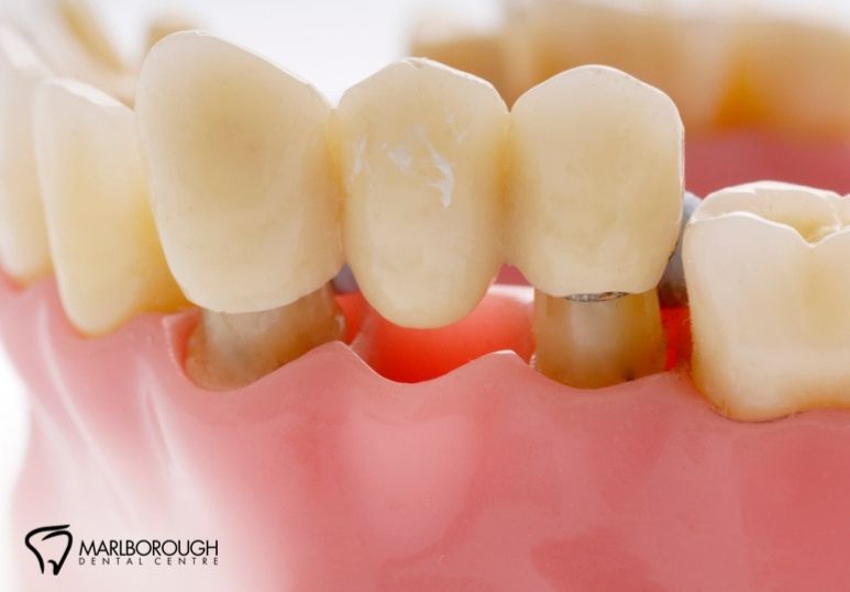 Bridging the Gap: How Dental Bridges Restore Function & Confidence