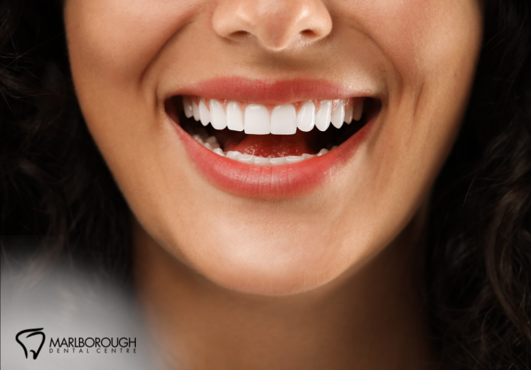 Are Veneers Right for You? Here’s How to Decide 