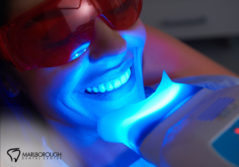  Is It Safe to Whiten Your Teeth at Home? What a Calgary Dentist Recommends 