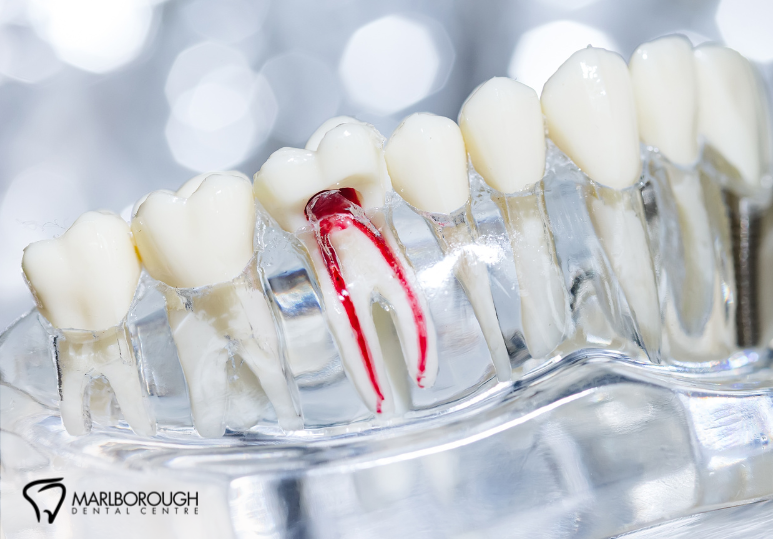 What to Expect During a Root Canal at Our Calgary Dental Clinic