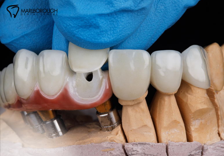 3 Warning Signs You Might Need a Dental Crown in Calgary 