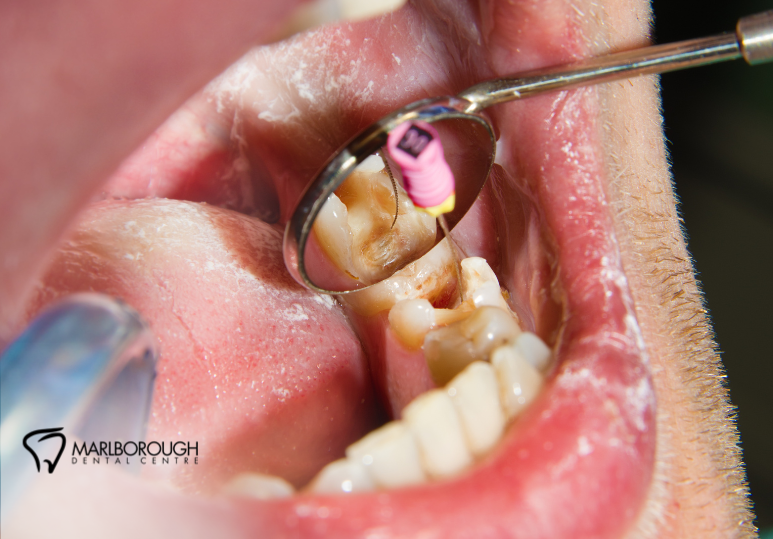 Root Canal Relief: What to Expect at Marlborough Dental Centre 