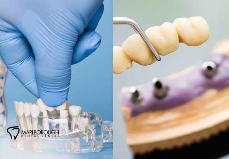 Crowns vs. Bridges: Choosing the Right Fix for Calgary Patients