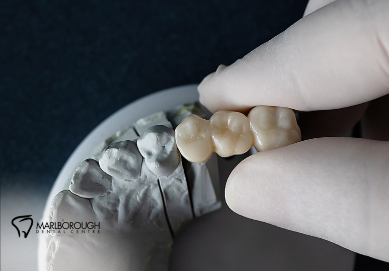 Dental Crowns: Is Spring the Right Time to Repair a Damaged Tooth? 