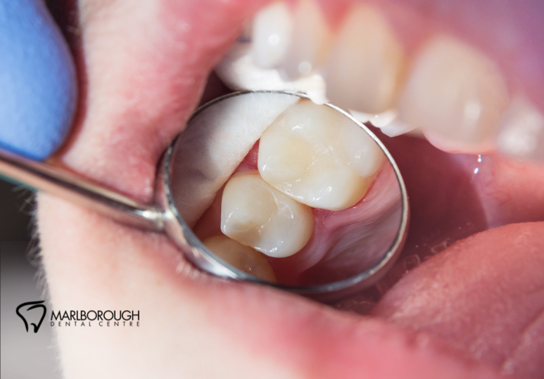 Tooth-Coloured Fillings: Discreet Cavity Repair for a Confident Smile